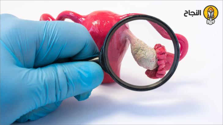 متلازمة المبيض متعدد الكُييسات: أعراضها، وأسبابها، وطرق علاجها