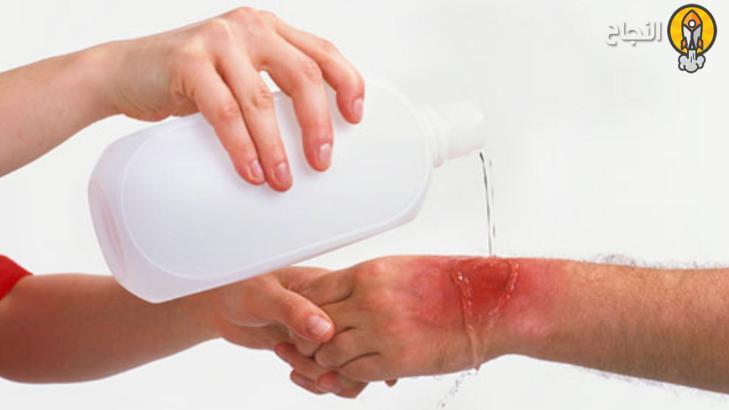 نصائح مهمة وسريعة لعلاج مختلف أنواع الحروق