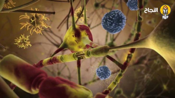 4  أسباب تقف وراء الإصابة بالتصلّب المتعدّد