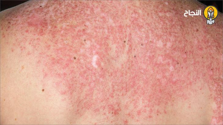 تعرف على مرض الذئبة الحمامية الجهازية